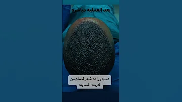 خطوات عمليه زراعه الشعر مع د.احمد مكاوي