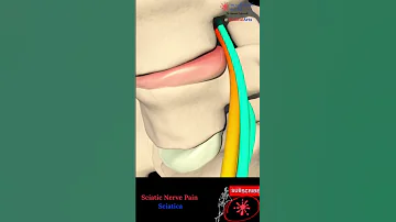 [EN] Sciatica nerve ❤️❌