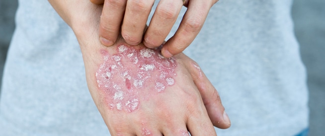 Psoriasis: Causes, Symptoms and Treatment