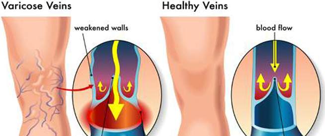 Varikosis: Causes, Symptoms and Treatment