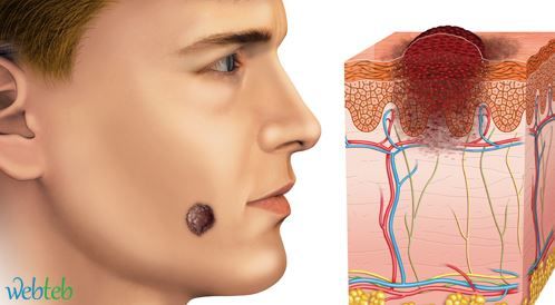 Watch the video: How is cancer spread?