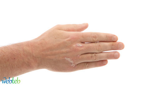 Look with photos: Types of psoriasis skin