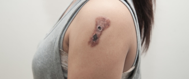 Skin Cancer: Causes, Symptoms and Treatment