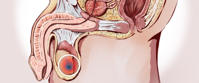 Test Cancer: Causes, Symptoms and Treatment