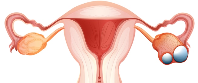 Ovarian cancer: Causes, symptoms and treatment