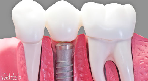 Watch the video: Dental implants
