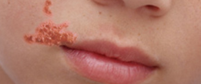 OBSECT DISEASE: Symptoms, Causes and Treatment